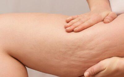 Cellulite à la ménopause : causes et solutions naturelles
