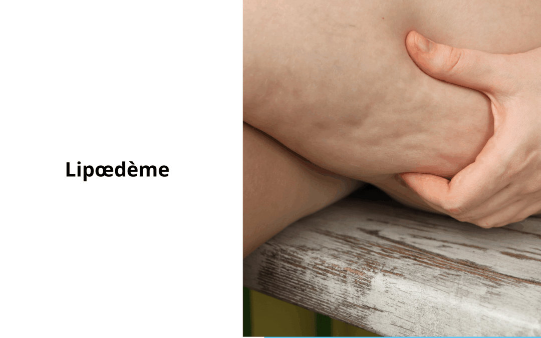 traitement naturel du lipoedeme
