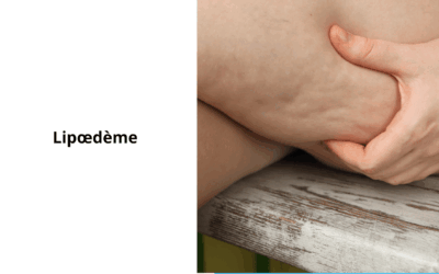 Lipœdème : Approche Intégrative entre Médecine Conventionnelle et Médecines Douces