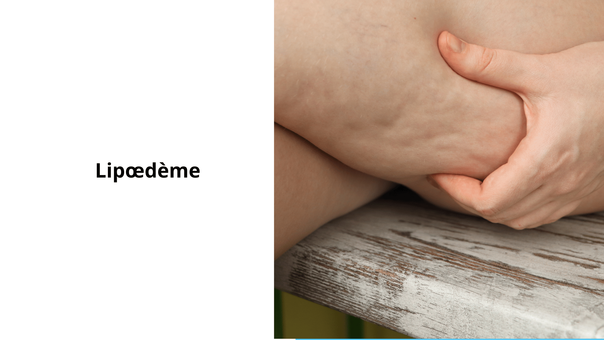 traitement naturel du lipoedeme