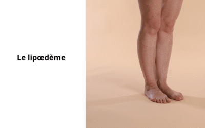 Lipœdème : prendre soin du terrain, au-delà des jambes